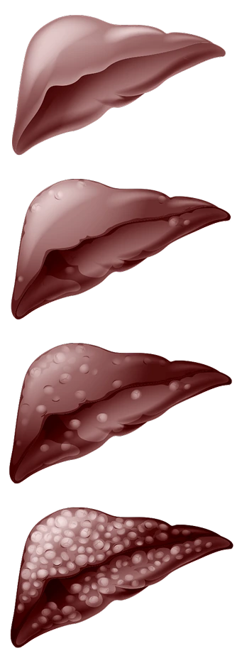 Liver damages